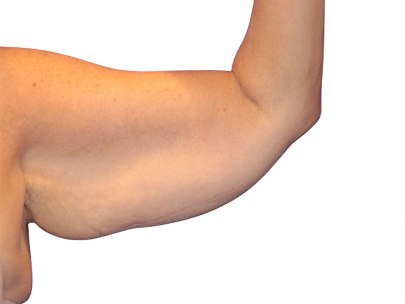 Brachioplasty Before & After Gallery - Patient 409793 - Image 7