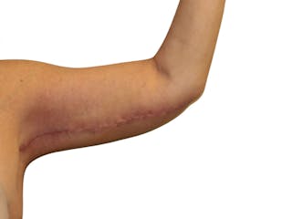 Brachioplasty Before & After Gallery - Patient 409793 - Image 8