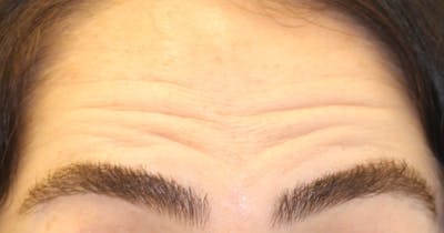 Botox Before & After Gallery - Patient 214875 - Image 1