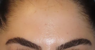 Botox Before & After Gallery - Patient 214875 - Image 2