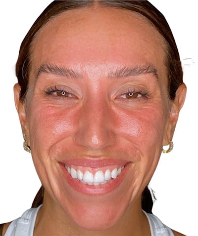 Botox Before & After Gallery - Patient 175741 - Image 1
