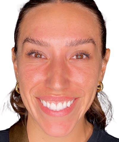 Botox Before & After Gallery - Patient 175741 - Image 2