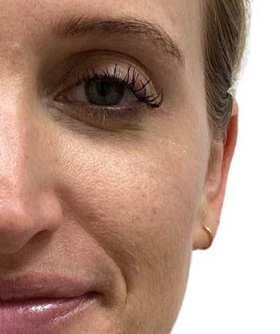 Botox Before & After Gallery - Patient 313790 - Image 1