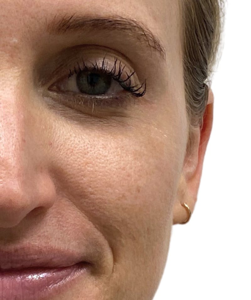 Botox Before & After Gallery - Patient 313790 - Image 1