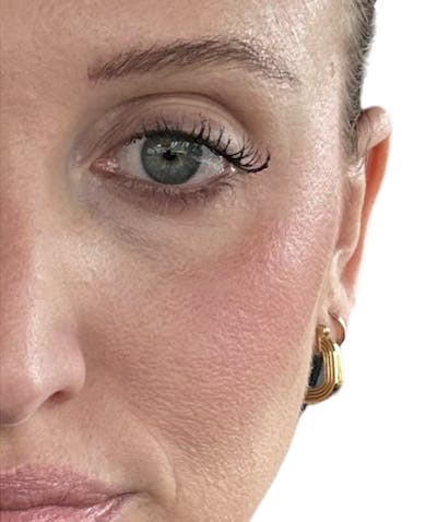 Botox Before & After Gallery - Patient 313790 - Image 2