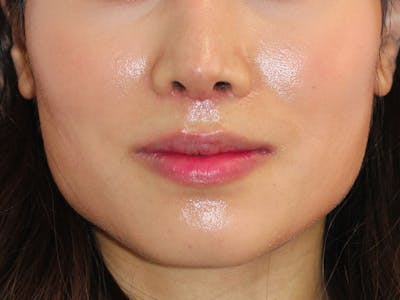 Botox Before & After Gallery - Patient 388369 - Image 1