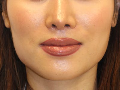 Botox Before & After Gallery - Patient 388369 - Image 2