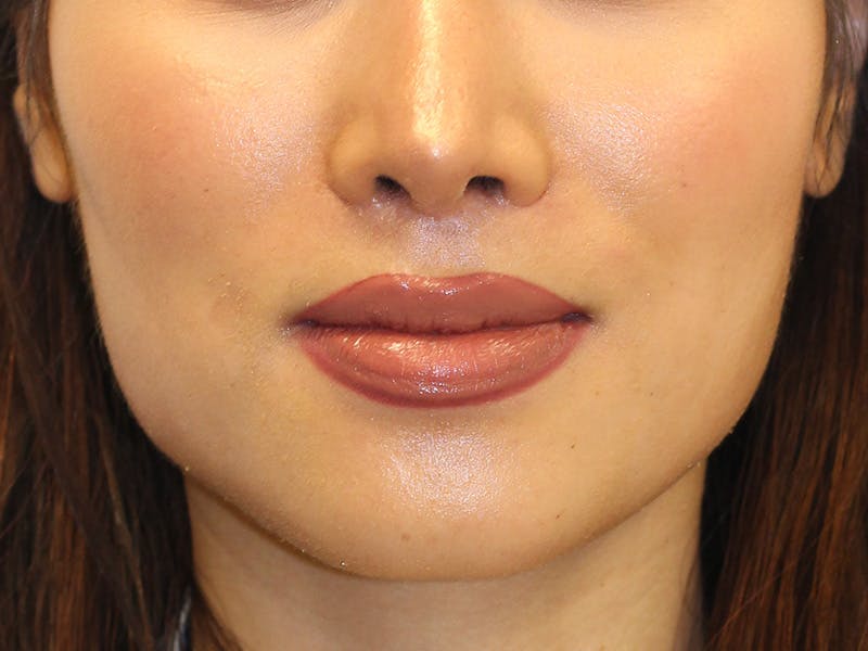 Botox Before & After Gallery - Patient 388369 - Image 2