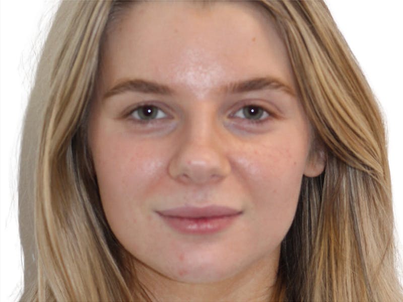 Botox Before & After Gallery - Patient 120755 - Image 1