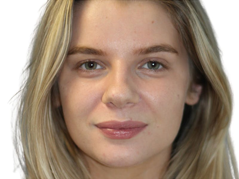 Botox Before & After Gallery - Patient 120755 - Image 2