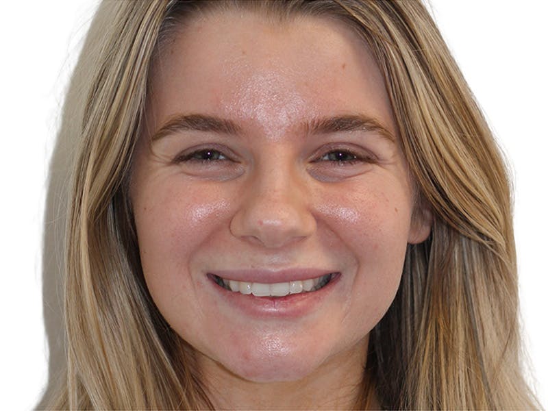 Botox Before & After Gallery - Patient 120755 - Image 3