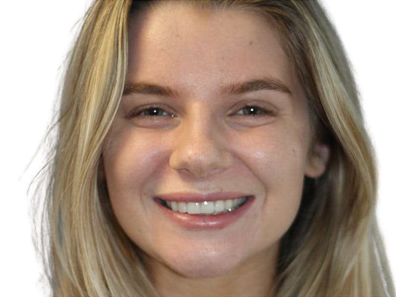 Botox Before & After Gallery - Patient 120755 - Image 4