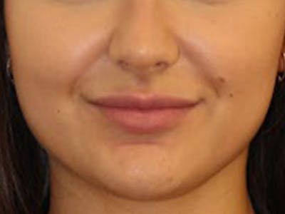 Botox Before & After Gallery - Patient 136962 - Image 1