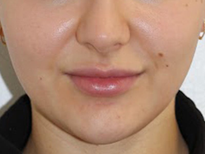 Botox Before & After Gallery - Patient 136962 - Image 2