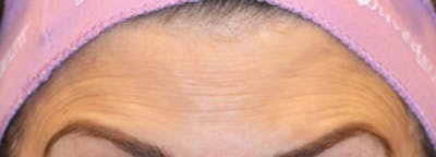 Botox Before & After Gallery - Patient 334901 - Image 1