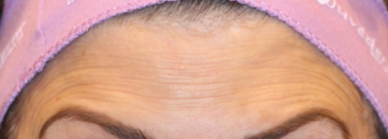 Botox Before & After Gallery - Patient 334901 - Image 1