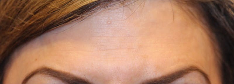 Botox Before & After Gallery - Patient 334901 - Image 2