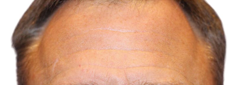 Botox Before & After Gallery - Patient 361045 - Image 1