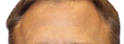 Botox Before & After Gallery - Patient 361045 - Image 2