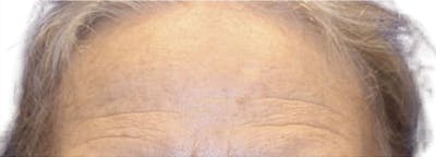 Botox Before & After Gallery - Patient 399881 - Image 1