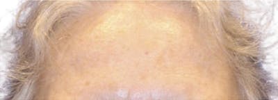 Botox Before & After Gallery - Patient 399881 - Image 2