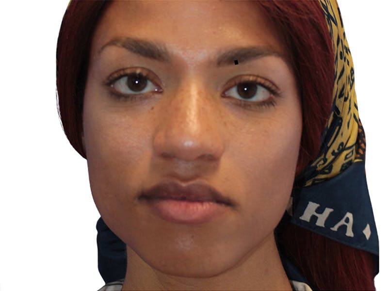 Botox Before & After Gallery - Patient 408228 - Image 1