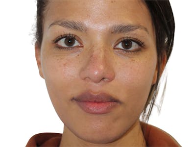 Botox Before & After Gallery - Patient 408228 - Image 2