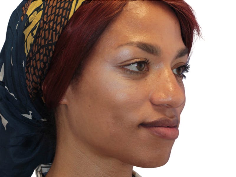 Botox Before & After Gallery - Patient 408228 - Image 3