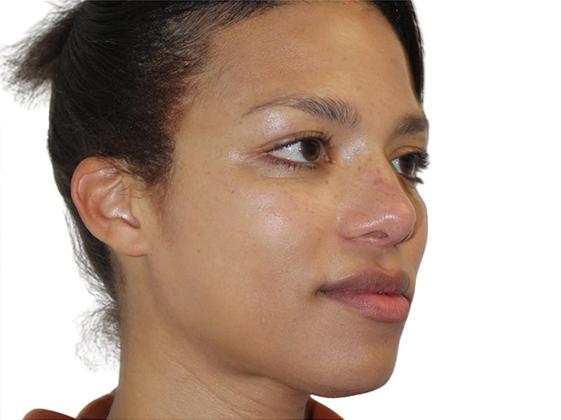 Botox Before & After Gallery - Patient 408228 - Image 4