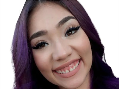 Botox Before & After Gallery - Patient 836338 - Image 1