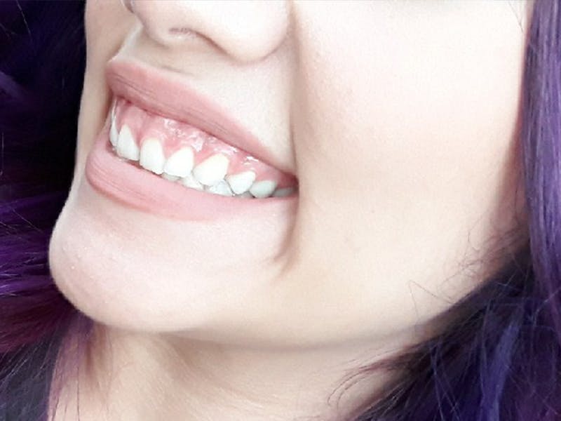 Botox Before & After Gallery - Patient 836338 - Image 3