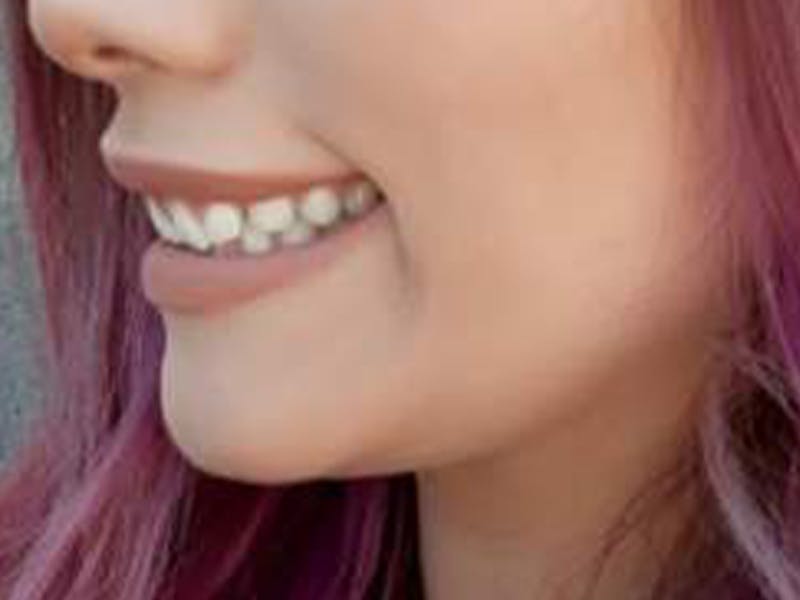 Botox Before & After Gallery - Patient 836338 - Image 4