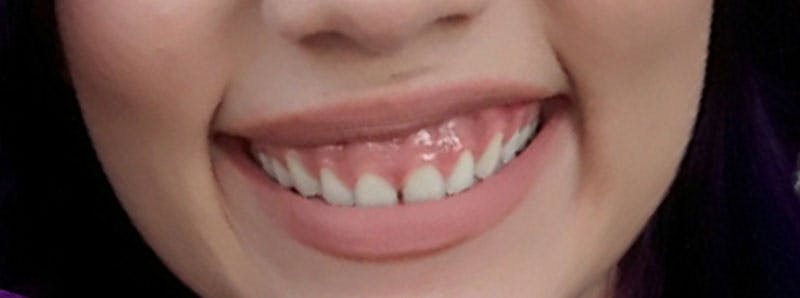 Botox Before & After Gallery - Patient 836338 - Image 5