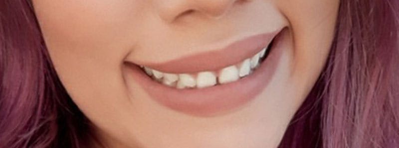 Botox Before & After Gallery - Patient 836338 - Image 6