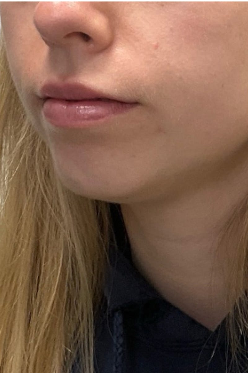 Filler Before & After Gallery - Patient 121966 - Image 1