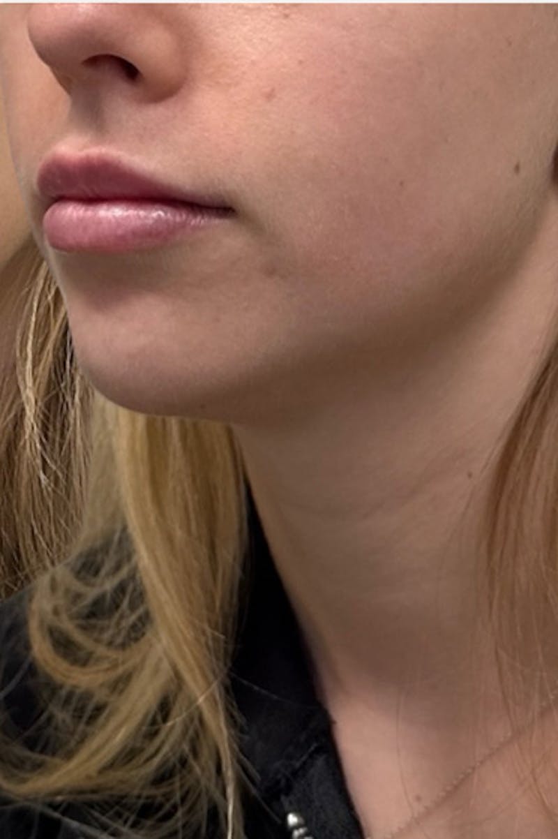 Filler Before & After Gallery - Patient 121966 - Image 2