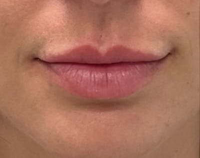 Filler Before & After Gallery - Patient 185995 - Image 1