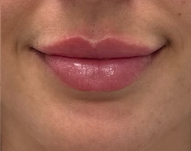 Filler Before & After Gallery - Patient 185995 - Image 2