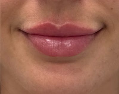 Filler Before & After Gallery - Patient 185995 - Image 2