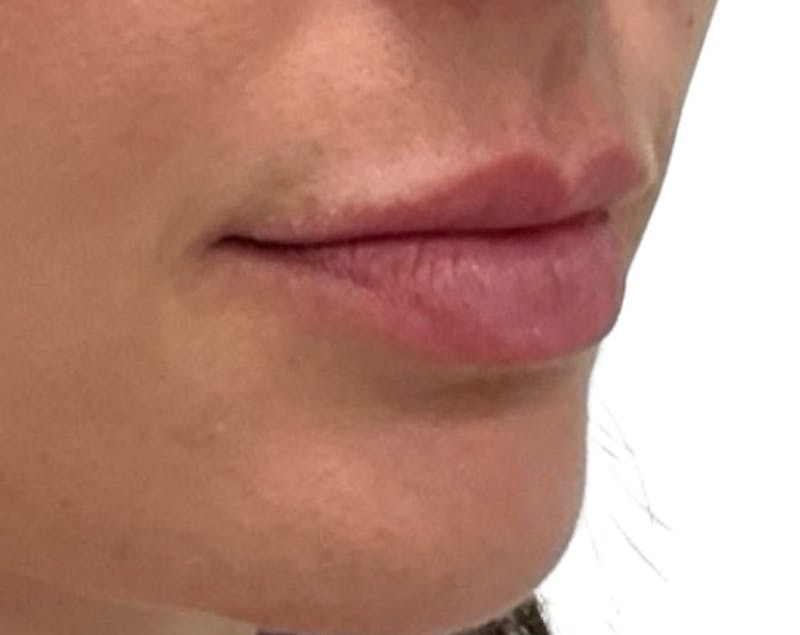 Filler Before & After Gallery - Patient 185995 - Image 3