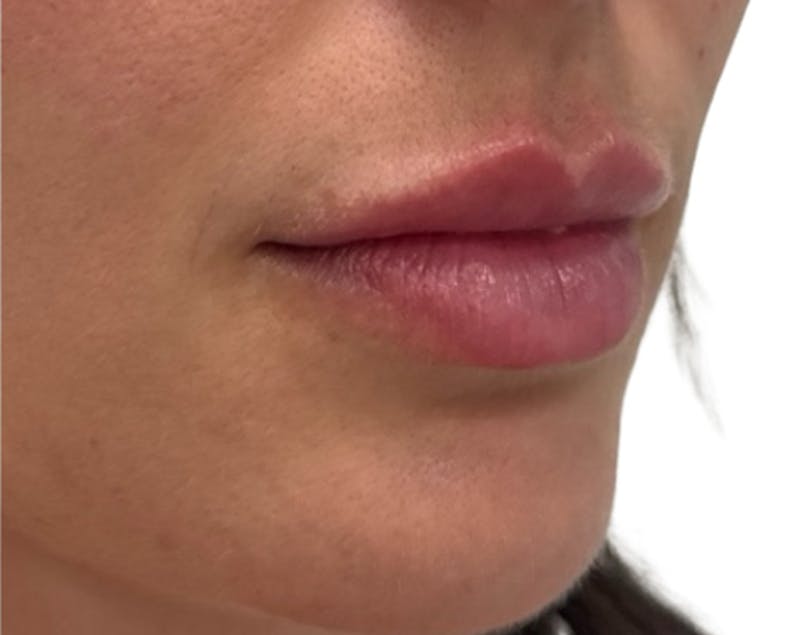 Filler Before & After Gallery - Patient 185995 - Image 4