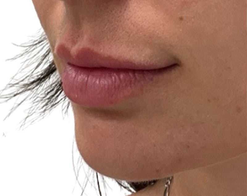 Filler Before & After Gallery - Patient 185995 - Image 5