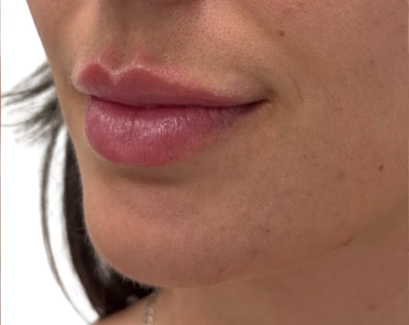 Filler Before & After Gallery - Patient 185995 - Image 6