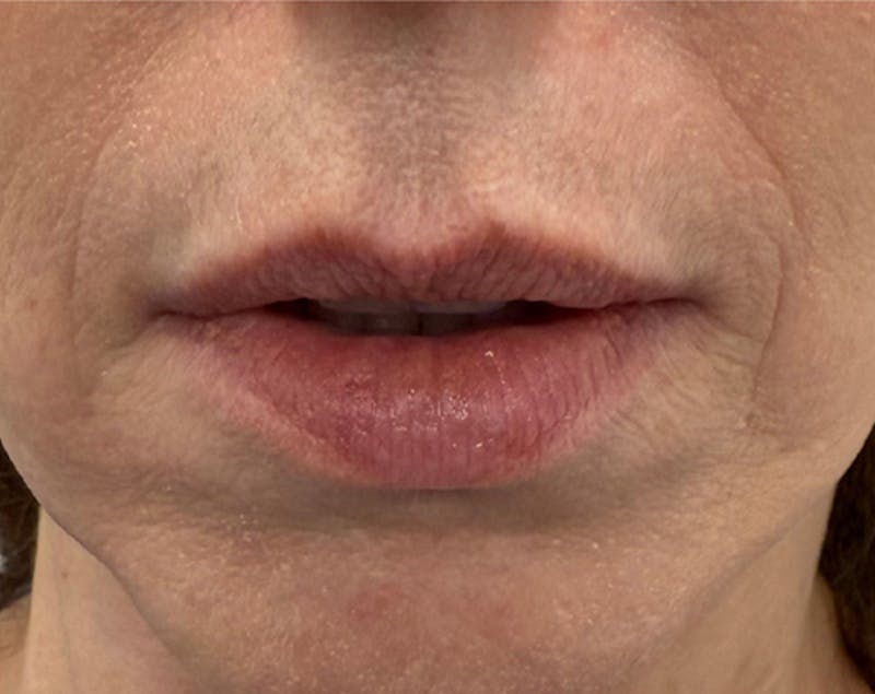 Filler Before & After Gallery - Patient 361856 - Image 1