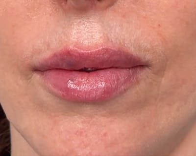 Filler Before & After Gallery - Patient 361856 - Image 2