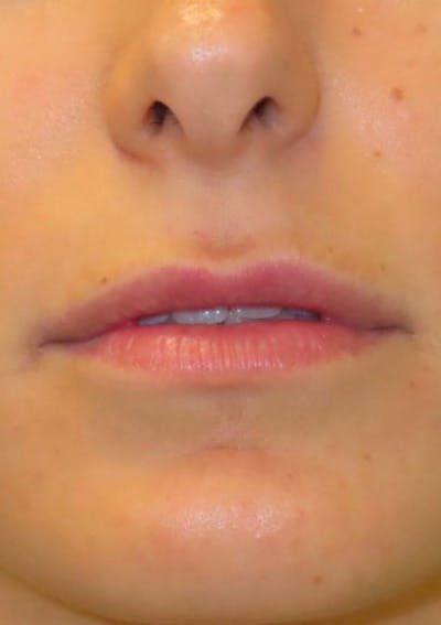 Filler Before & After Gallery - Patient 174603 - Image 1