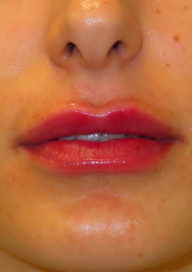Filler Before & After Gallery - Patient 174603 - Image 2