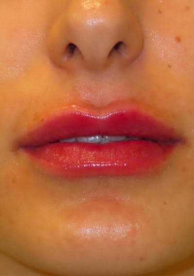 Filler Before & After Gallery - Patient 174603 - Image 2