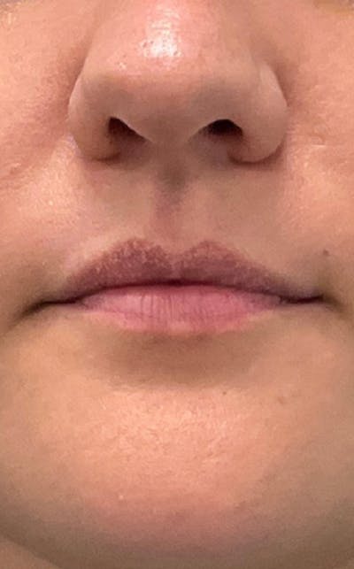 Filler Before & After Gallery - Patient 454363 - Image 1