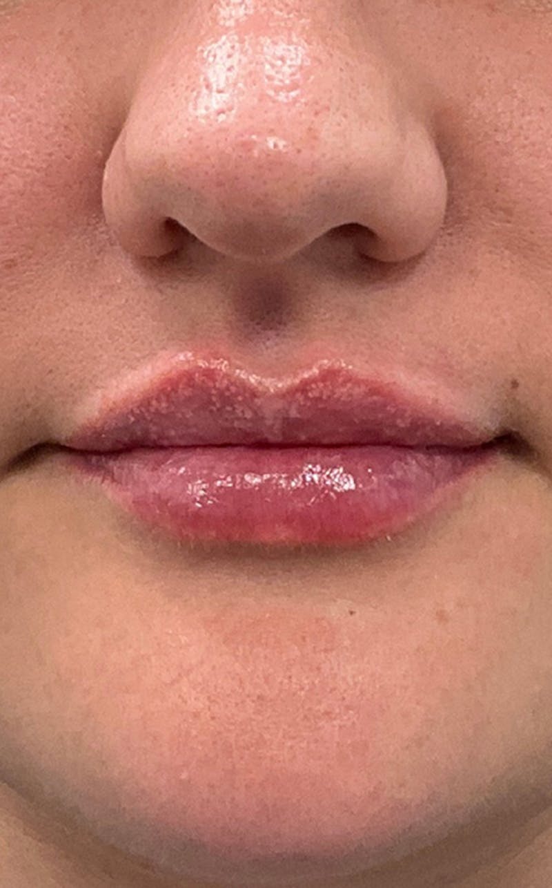 Filler Before & After Gallery - Patient 454363 - Image 2